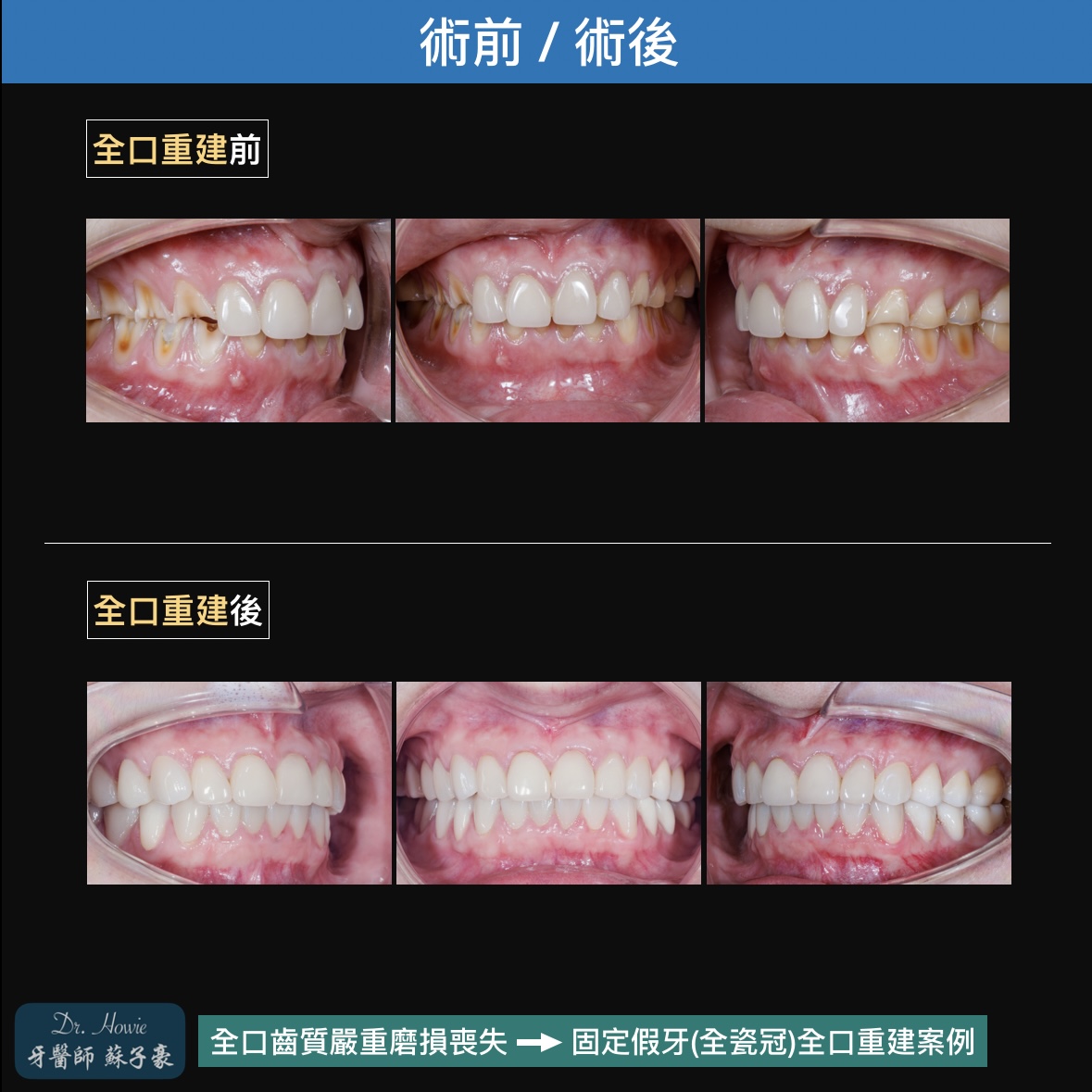 全口齒質嚴重磨損喪失 >> 固定假牙全口重建複雜案例
