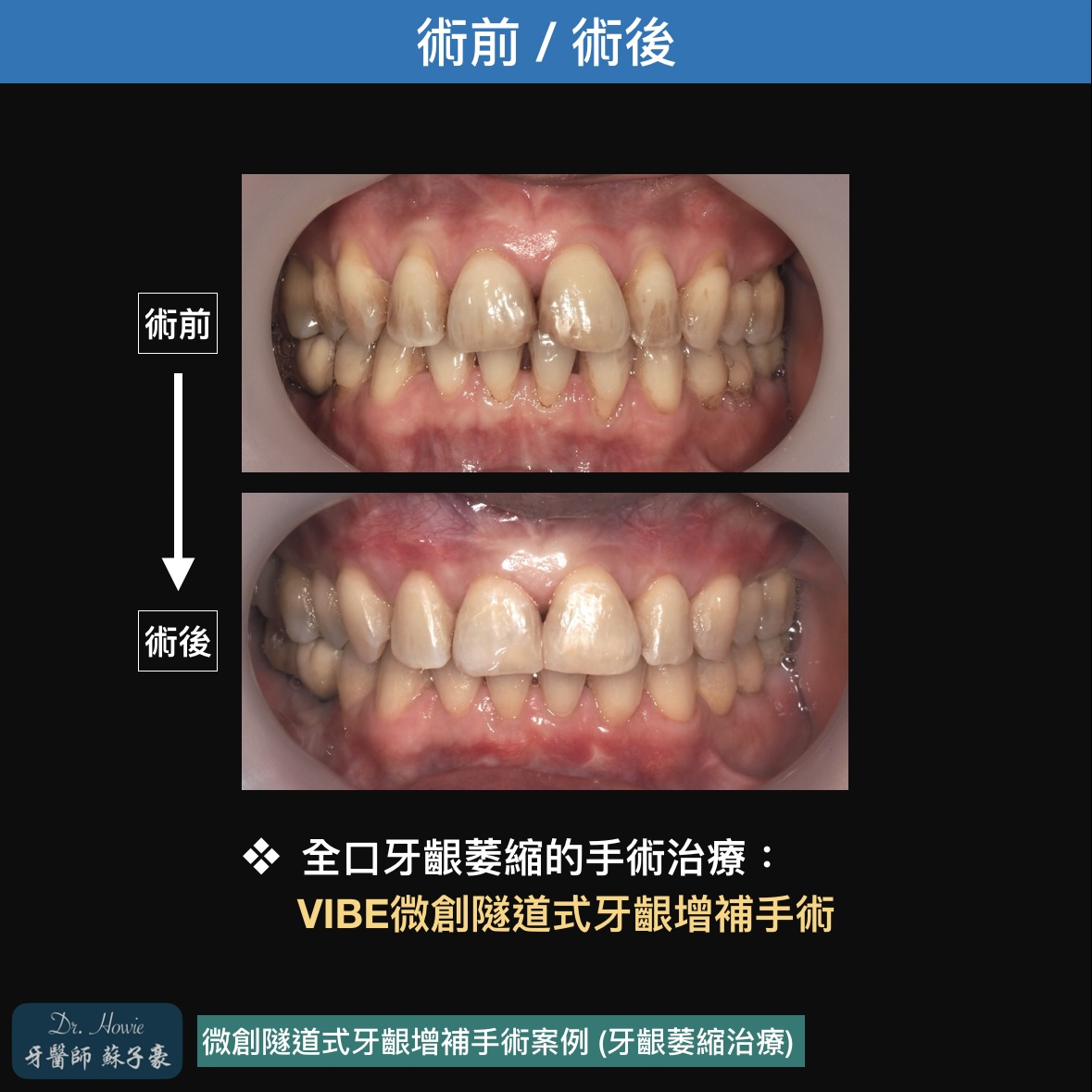 牙齦萎縮 >> 微創隧道式牙齦增補手術案例1