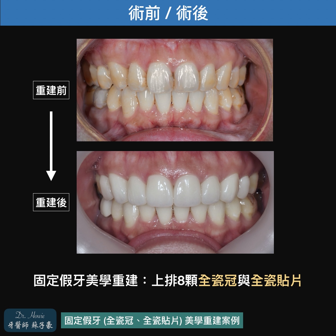 固定假牙 (全瓷冠、全瓷貼片) 全口美學重建案例3