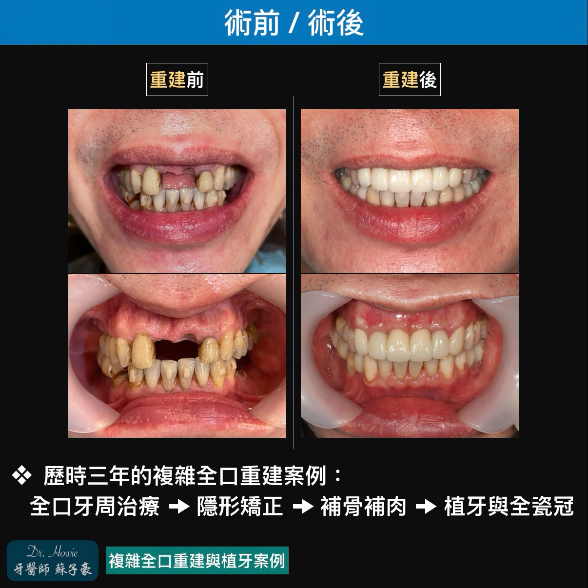 複雜全口重建與植牙案例2
