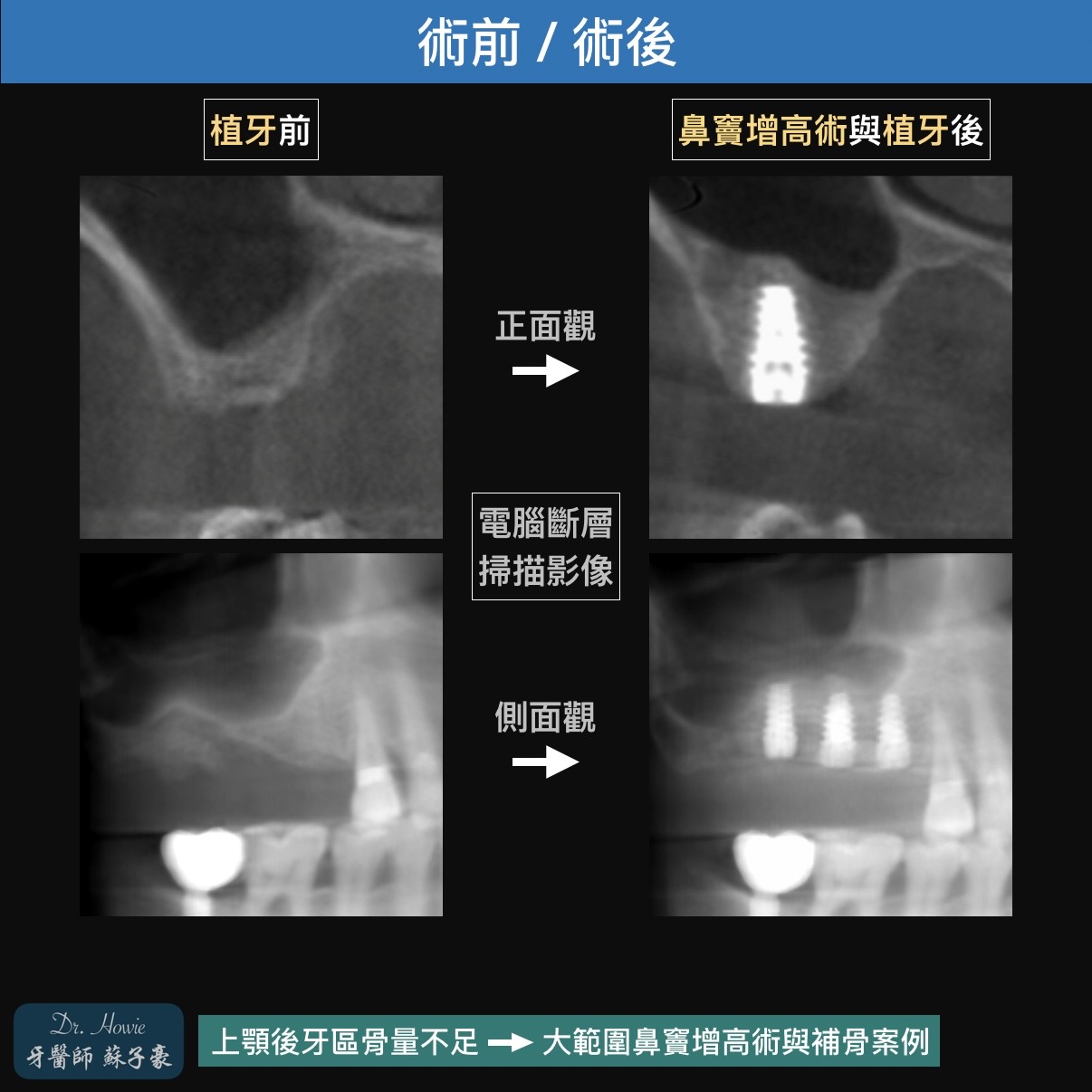 上顎後牙區骨量不足 >> 大範圍鼻竇增高術與補骨案例1