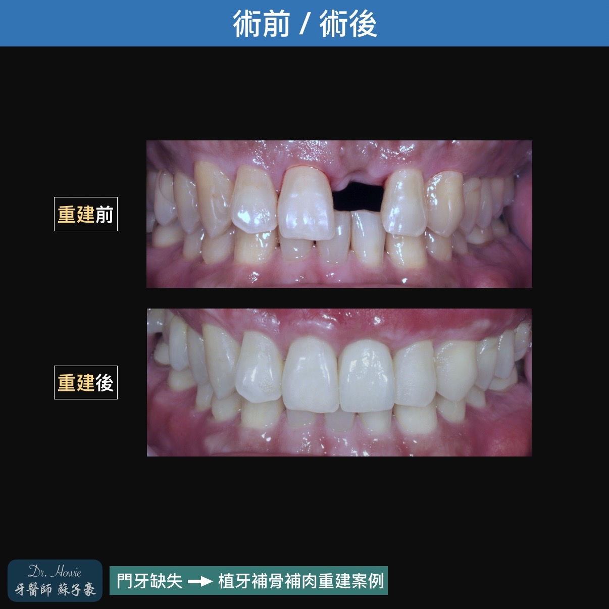 美觀區植牙與補骨補肉重建案例