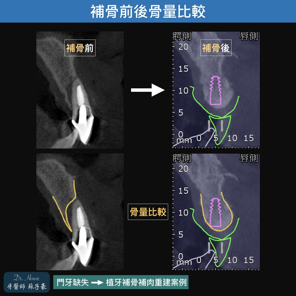 門牙縱裂 >> 美觀區補骨與植牙重建案例