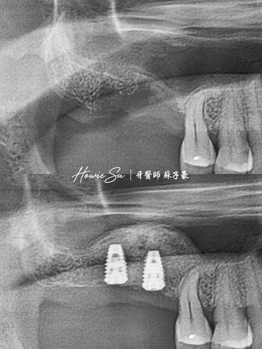 上顎後牙區骨量不足 >> 大範圍鼻竇增高術與補骨案例2