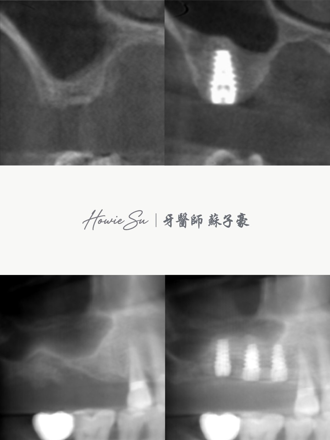 上顎後牙區骨量不足 >> 大範圍鼻竇增高術與補骨案例1
